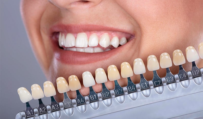 راهنمای انتخاب رنگ لمینت دندان برای لبخندی زیبا و طبیعی