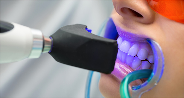 بلیچینگ دندان با لیزر